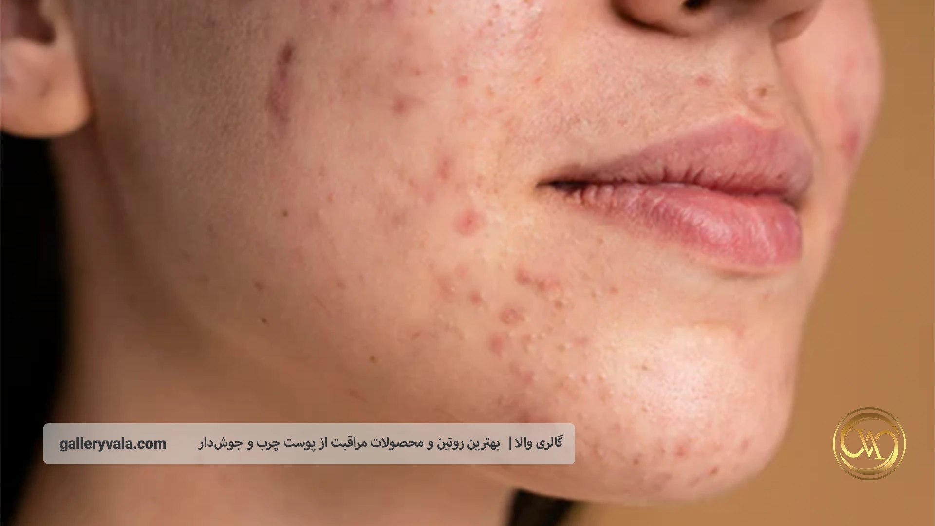 روتین روزانه مراقبت از پوست چرب و جوش دار