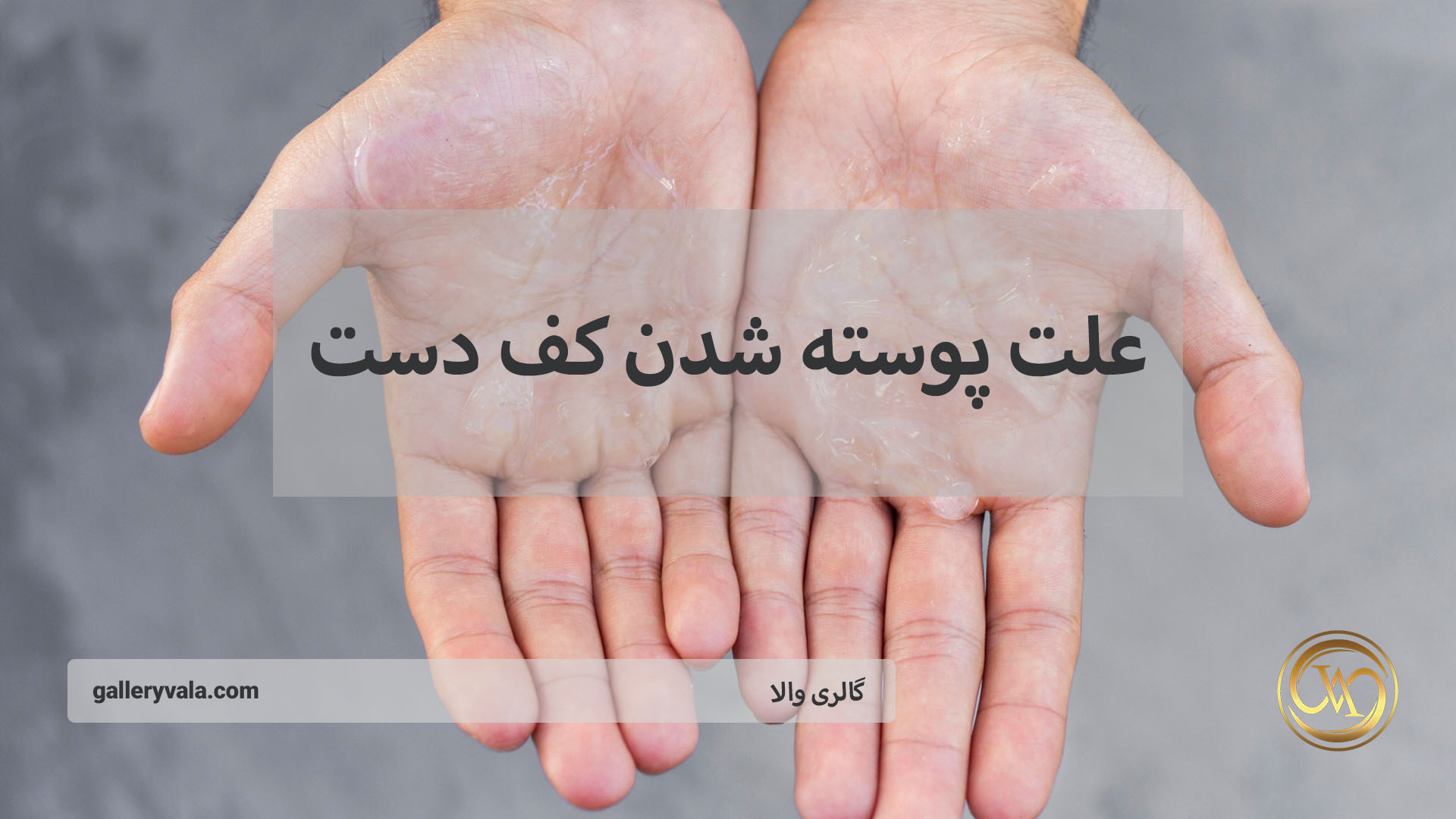 علت پوسته شدن کف دست: کمبود کدام ویتامین‌ها نقش دارد؟ | گالری والا